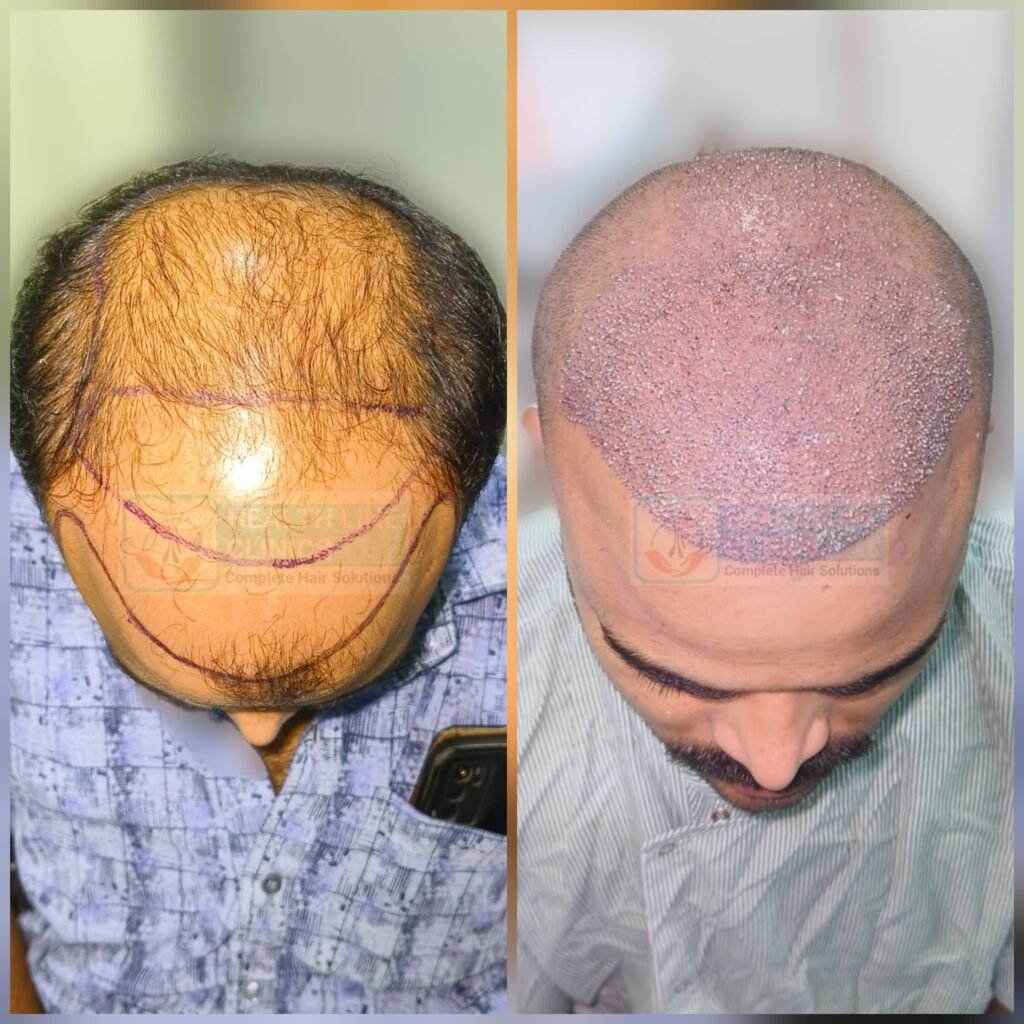 Hair Transplsant clinic in kanpur @Health Line Clinic